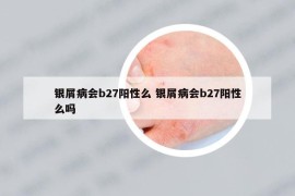 銀屑病會(huì)b27陽(yáng)性么 銀屑病會(huì)b27陽(yáng)性么嗎
