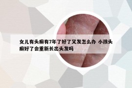 女兒有頭癬有7年了好了又發(fā)怎么辦 小孩頭癬好了會(huì)重新長(zhǎng)出頭發(fā)嗎