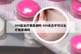999能治療銀屑病嗎 999皮炎平可以治療銀屑病嗎