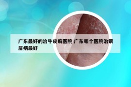 廣東最好的冶牛皮癬醫(yī)院 廣東哪個醫(yī)院治銀屑病最好