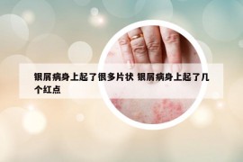 銀屑病身上起了很多片狀 銀屑病身上起了幾個紅點(diǎn)