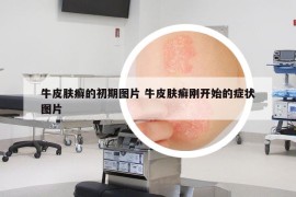 牛皮膚癬的初期圖片 牛皮膚癬剛開(kāi)始的癥狀圖片