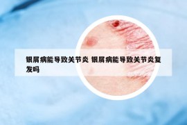 銀屑病能導(dǎo)致關(guān)節(jié)炎 銀屑病能導(dǎo)致關(guān)節(jié)炎復(fù)發(fā)嗎