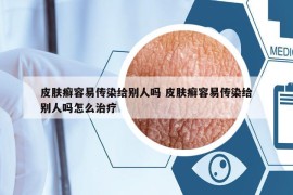 皮膚癬容易傳染給別人嗎 皮膚癬容易傳染給別人嗎怎么治療