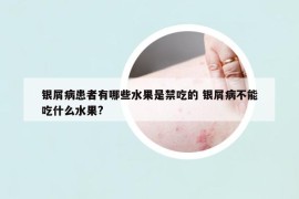 銀屑病患者有哪些水果是禁吃的 銀屑病不能吃什么水果?