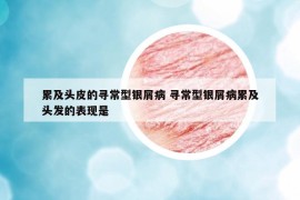 累及頭皮的尋常型銀屑病 尋常型銀屑病累及頭發(fā)的表現(xiàn)是