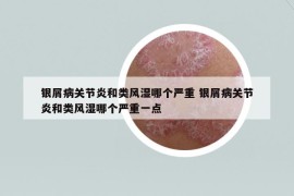 銀屑病關(guān)節(jié)炎和類風(fēng)濕哪個嚴(yán)重 銀屑病關(guān)節(jié)炎和類風(fēng)濕哪個嚴(yán)重一點
