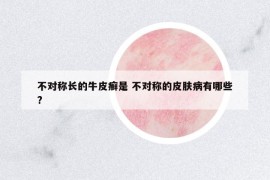 不對稱長的牛皮癬是 不對稱的皮膚病有哪些?