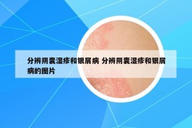 分辨陰囊濕疹和銀屑病 分辨陰囊濕疹和銀屑病的圖片