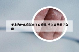 手上為什么突然有了白癜風(fēng) 手上突然起了白斑
