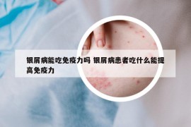 銀屑病能吃免疫力嗎 銀屑病患者吃什么能提高免疫力