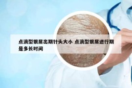 點滴型銀屑出期針頭大小 點滴型銀屑進(jìn)行期是多長時間
