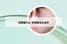 石癬是什么 石斑癬怎么治療
