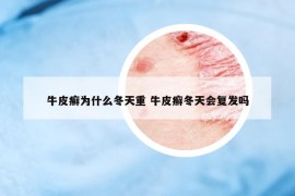 牛皮癬為什么冬天重 牛皮癬冬天會(huì)復(fù)發(fā)嗎