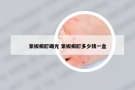 紫椒癬酊曝光 紫椒癬酊多少錢一盒