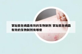 掌趾膿包病最有效的生物制劑 掌趾膿包病最有效的生物制劑有哪些