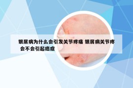 銀屑病為什么會引發(fā)關(guān)節(jié)疼痛 銀屑病關(guān)節(jié)疼 會不會引起癌癥