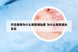 作息規(guī)律為什么銀屑病加重 為什么銀屑病會(huì)自愈