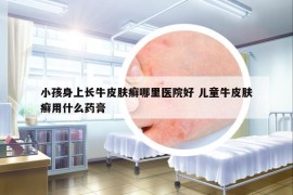 小孩身上長牛皮膚癬哪里醫(yī)院好 兒童牛皮膚癬用什么藥膏
