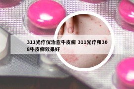 311光療儀治愈牛皮癬 311光療和308牛皮癬效果好