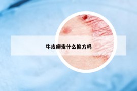 牛皮癬走什么偏方嗎