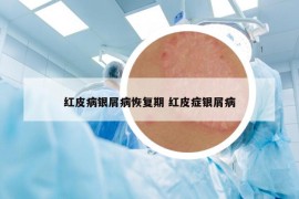 紅皮病銀屑病恢復(fù)期 紅皮癥銀屑病
