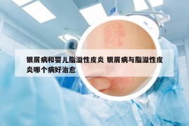銀屑病和嬰兒脂溢性皮炎 銀屑病與脂溢性皮炎哪個病好治愈