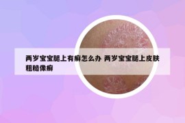 兩歲寶寶腿上有癬怎么辦 兩歲寶寶腿上皮膚粗糙像癬