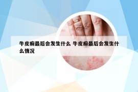 牛皮癬最后會發(fā)生什么 牛皮癬最后會發(fā)生什么情況