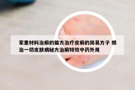 家里材料治癬的偏方治療皮癬的簡易方子 根治一切皮膚病秘方治癬特效中藥外用