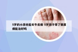5歲的小孩也能長牛皮癬 5歲孩子得了銀屑病能治好嗎