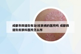 成都市四道街有治l皮膚病的醫(yī)院嗎 成都四道街皮膚科醫(yī)院怎么樣