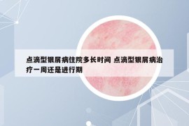 點(diǎn)滴型銀屑病住院多長(zhǎng)時(shí)間 點(diǎn)滴型銀屑病治療一周還是進(jìn)行期