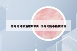 拔毒膏可以治銀屑病嗎 拔毒膏能不能拔破皮