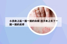 小孩身上起一圈一圈的白癬 孩子身上長了一圈一圈的皮疹