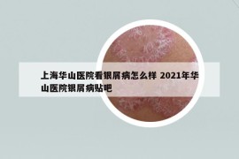 上海華山醫(yī)院看銀屑病怎么樣 2021年華山醫(yī)院銀屑病貼吧
