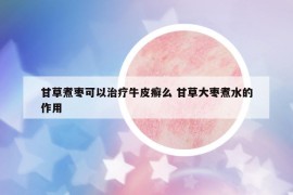 甘草煮棗可以治療牛皮癬么 甘草大棗煮水的作用