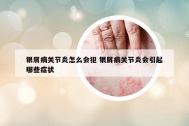 銀屑病關(guān)節(jié)炎怎么會犯 銀屑病關(guān)節(jié)炎會引起哪些癥狀
