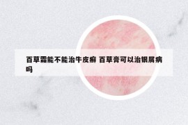 百草霜能不能治牛皮癬 百草膏可以治銀屑病嗎