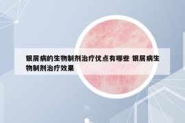 銀屑病的生物制劑治療優(yōu)點有哪些 銀屑病生物制劑治療效果