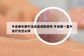 牛皮癬長期不治會變成癌癥嗎 牛皮癬一直不治療會怎么樣