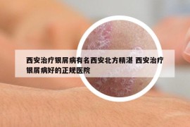 西安治療銀屑病有名西安北方精湛 西安治療銀屑病好的正規(guī)醫(yī)院