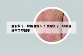 屁股長了一塊癬老好不了 屁股長了一塊癬老好不了咋回事