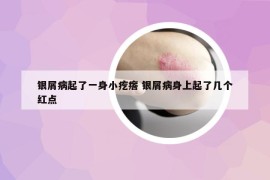 銀屑病起了一身小疙瘩 銀屑病身上起了幾個紅點