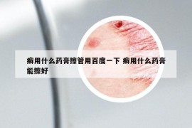 癬用什么藥膏擦管用百度一下 癬用什么藥膏能擦好
