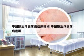 干細(xì)胞治療銀屑病臨床時間 干細(xì)胞治療銀屑病進(jìn)展