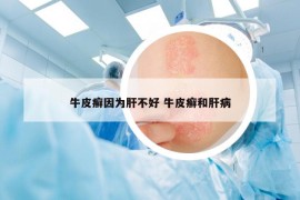 牛皮癬因為肝不好 牛皮癬和肝病