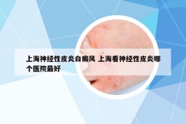 上海神經(jīng)性皮炎白癜風(fēng) 上?？瓷窠?jīng)性皮炎哪個(gè)醫(yī)院最好