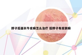 脖子后面長(zhǎng)牛皮癬怎么治療 后脖子有皮膚癬