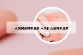 人為何會得牛皮癬 人為什么會得牛皮廨